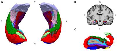 Morphometric and microstructural characteristics of hippocampal subfields in mesial temporal lobe epilepsy and their correlates with mnemonic discrimination